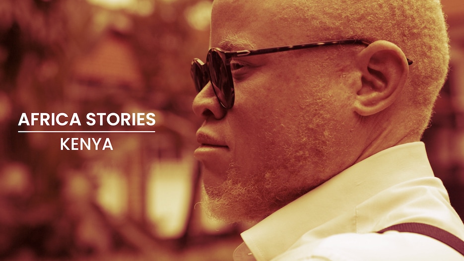 Black Albinism FC | Africa Stories